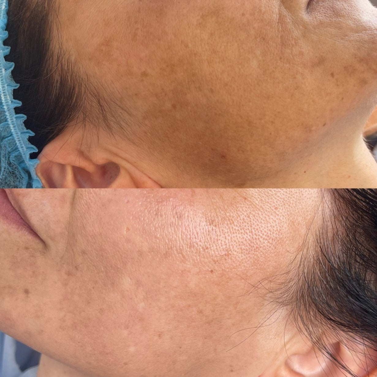 Dermaplaning Deposit (1 hour)