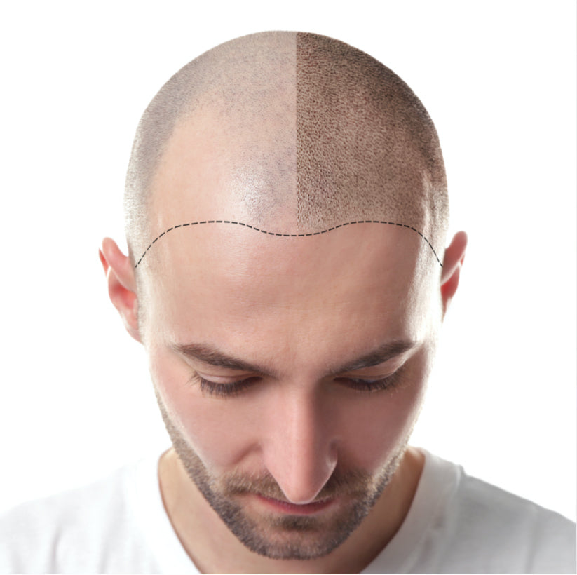 Scalp Micropigmentation